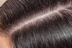 Selsun Shampoo: Niet Meer Te Koop in Nederland? Ontdek de Beste Alternatieven